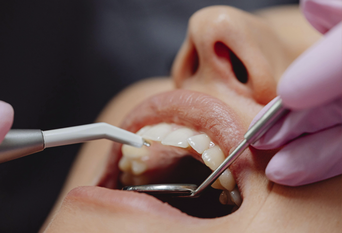 Sonde des Zahnarztes und Mundspiegel im Mund eines Patienten